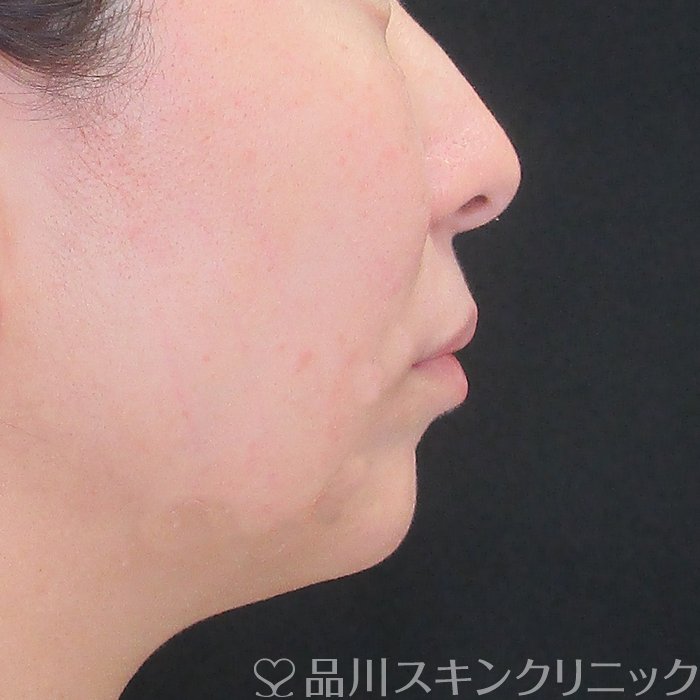 症例NO.73414のAFTER写真