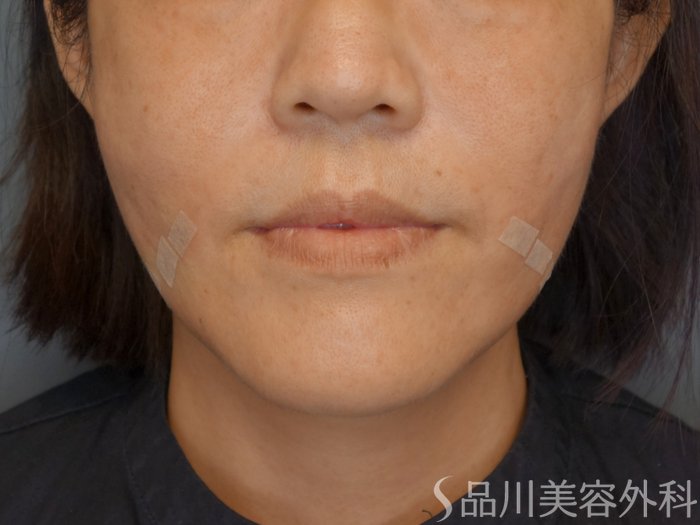 症例NO.71705のAFTER写真