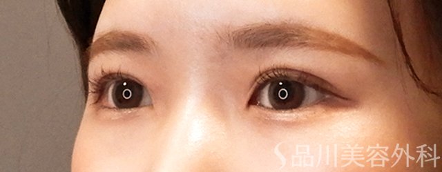 症例NO.70028のAFTER写真