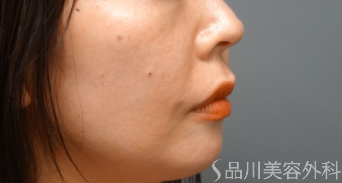 症例NO.65070のAFTER写真