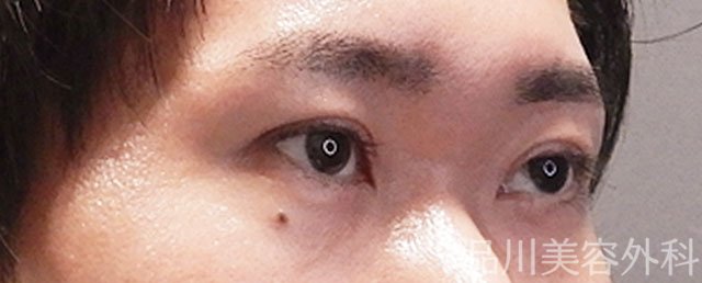 症例NO.72269のAFTER写真