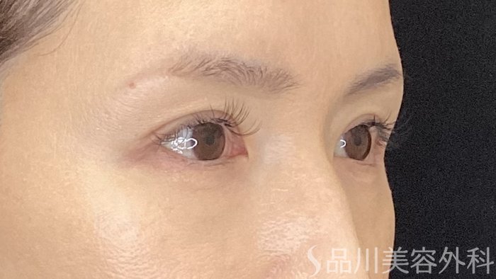 症例NO.73013のAFTER写真