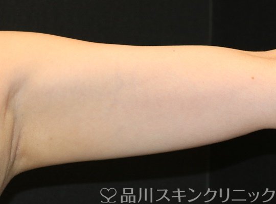 症例NO.75031のAFTER写真