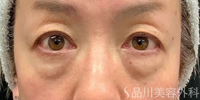 症例NO.71237のBEFORE写真