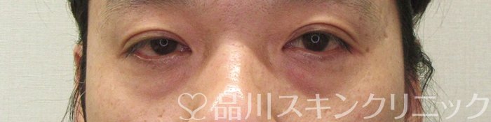 症例NO.71038のBEFORE写真