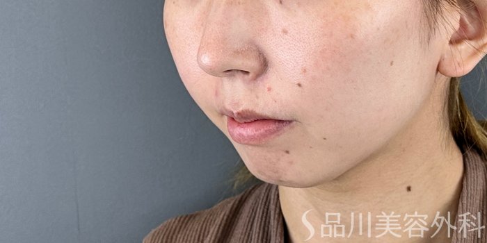 症例NO.71961のBEFORE写真