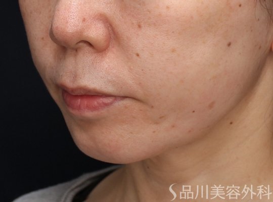 症例NO.73098のAFTER写真