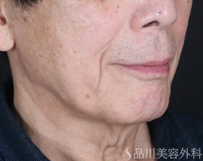 症例NO.73563のBEFORE写真