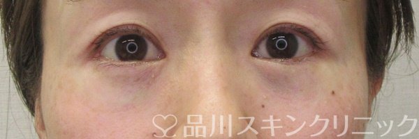 症例NO.69910のAFTER写真