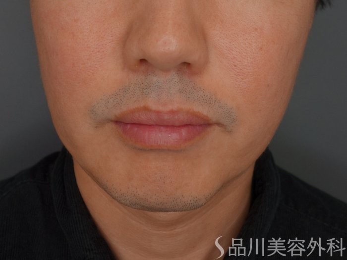 症例NO.75308のBEFORE写真