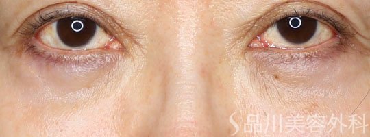 症例NO.72815のAFTER写真