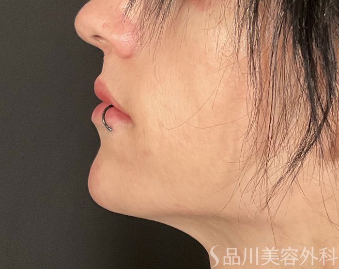 症例NO.75287のAFTER写真