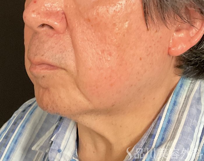 症例NO.74598のBEFORE写真