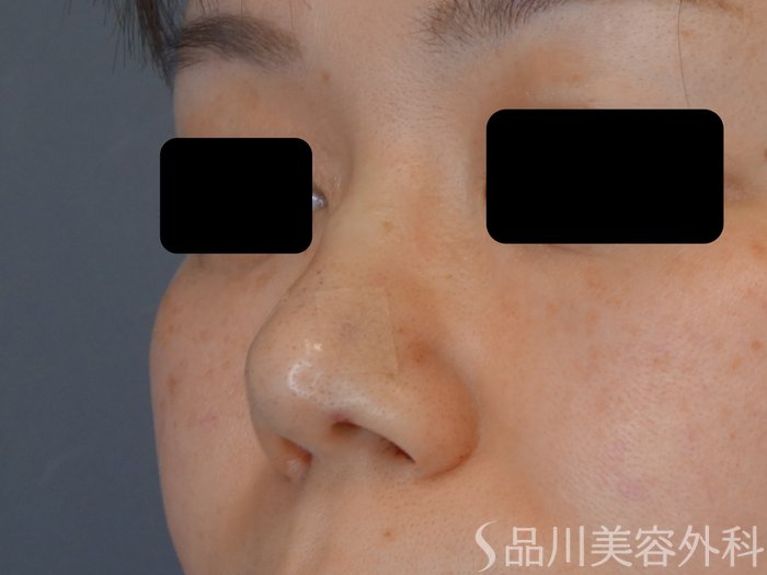 症例NO.72571のAFTER写真
