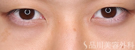 症例NO.71912のBEFORE写真