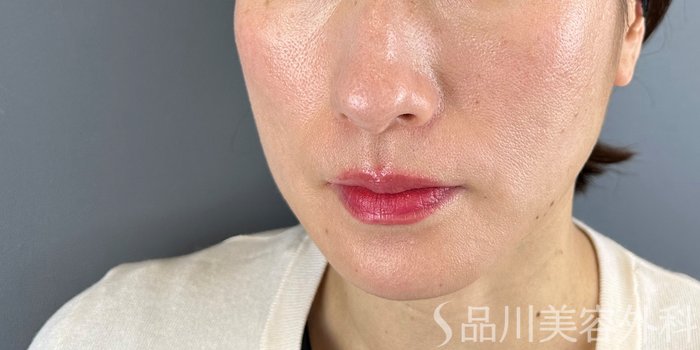 症例NO.70651のBEFORE写真