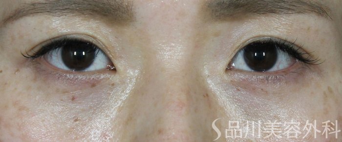 症例NO.71004のAFTER写真