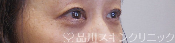 症例NO.70543のAFTER写真