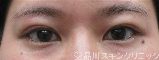 症例NO.60463のAFTER写真