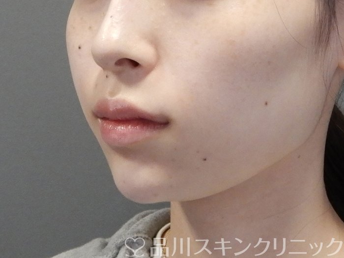 症例NO.70601のAFTER写真