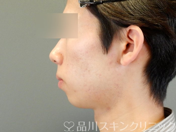症例NO.65027のAFTER写真