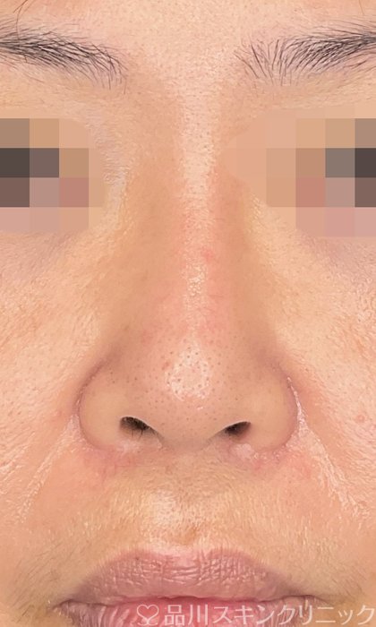 症例NO.75091のAFTER写真