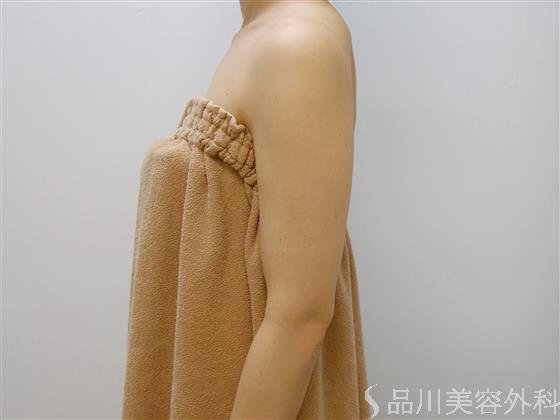 症例NO.51538のAFTER写真