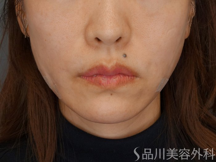 症例NO.72386のAFTER写真