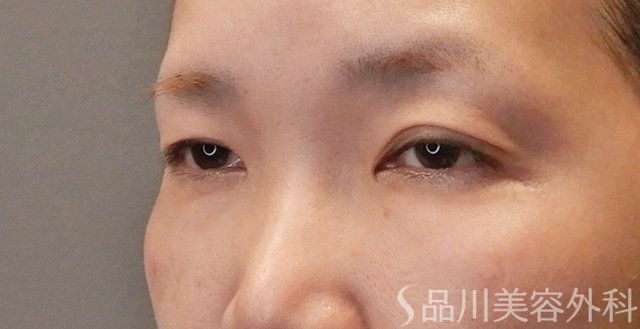 症例NO.74771のBEFORE写真