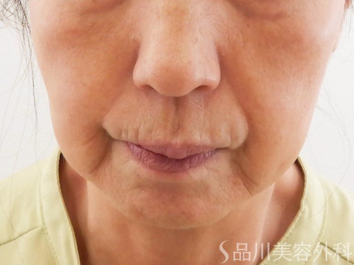症例NO.62187のBEFORE写真