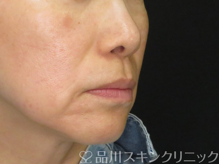症例NO.70136のBEFORE写真