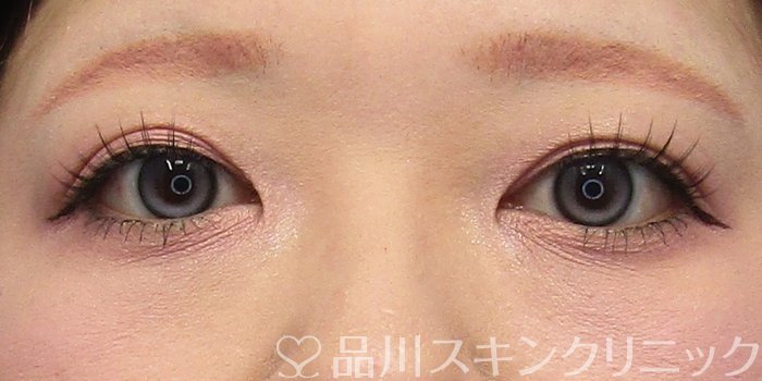 症例NO.74910のBEFORE写真