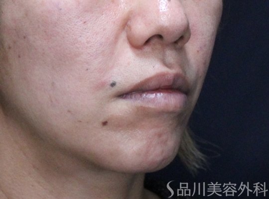 症例NO.73347のAFTER写真