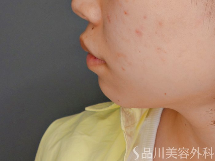 症例NO.64620のBEFORE写真