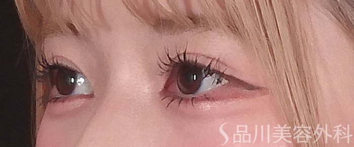 症例NO.69236のAFTER写真