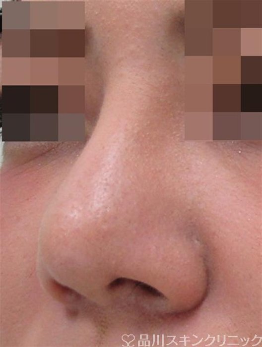症例NO.32660のAFTER写真