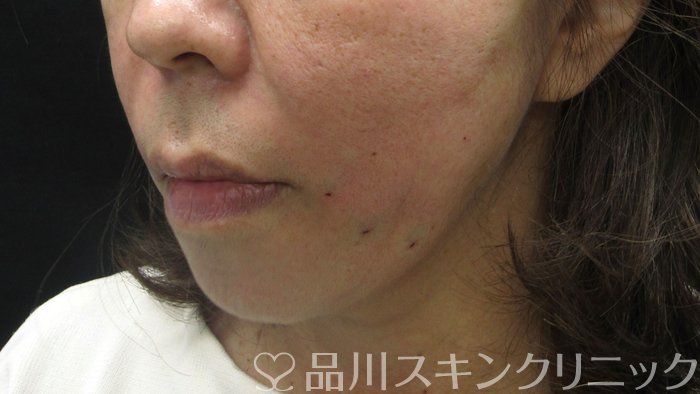症例NO.70507のAFTER写真