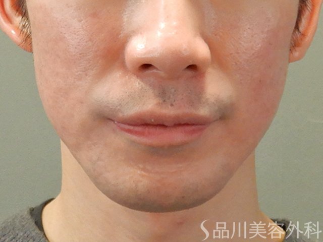 症例NO.72804のAFTER写真