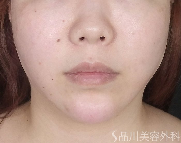 症例NO.65322のAFTER写真