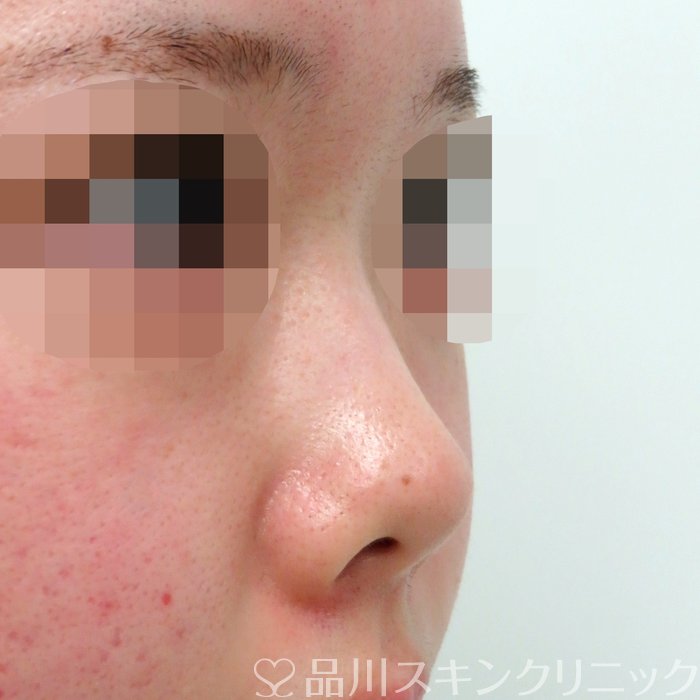 症例NO.71290のBEFORE写真