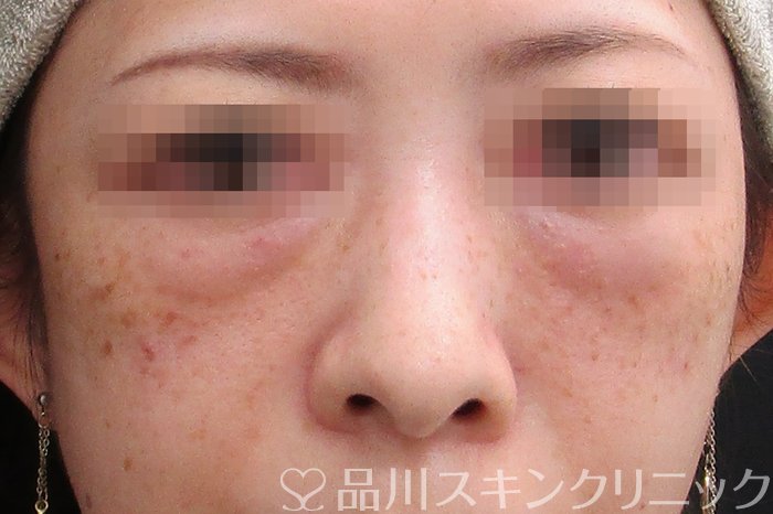 症例NO.75097のAFTER写真