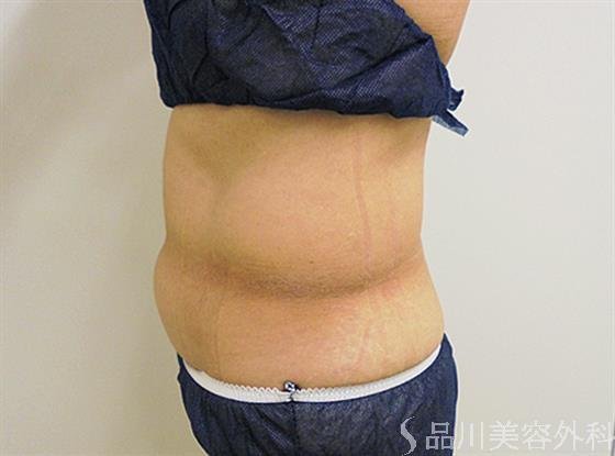 症例NO.22255のAFTER写真