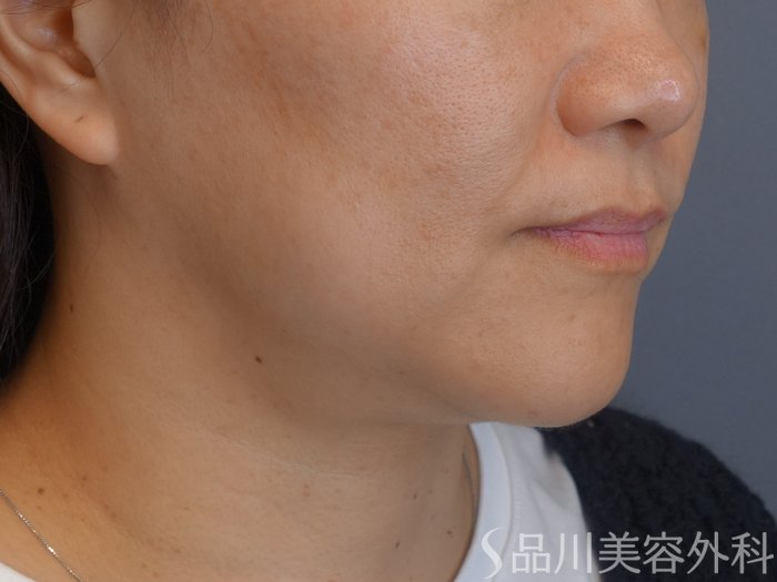 症例NO.72619のBEFORE写真