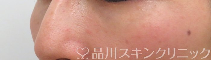 症例NO.66423のAFTER写真