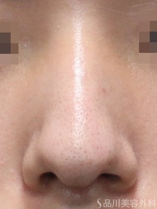 症例NO.75215のBEFORE写真