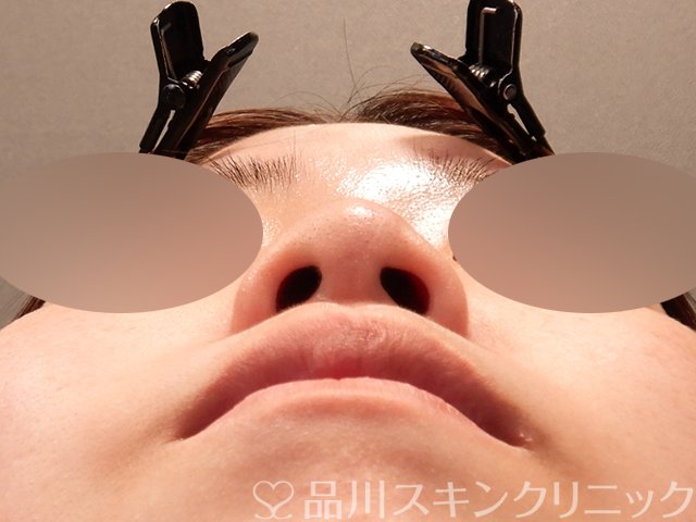 症例NO.71486のBEFORE写真