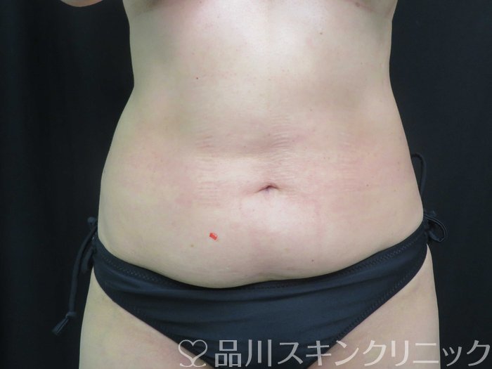 症例NO.74036のBEFORE写真