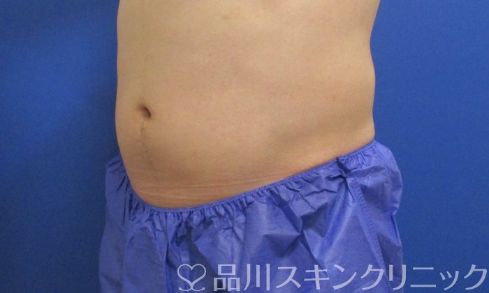 症例NO.70460のAFTER写真