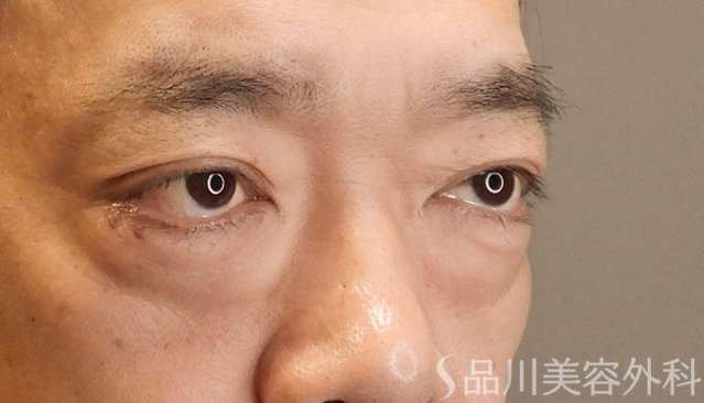 症例NO.75042のBEFORE写真