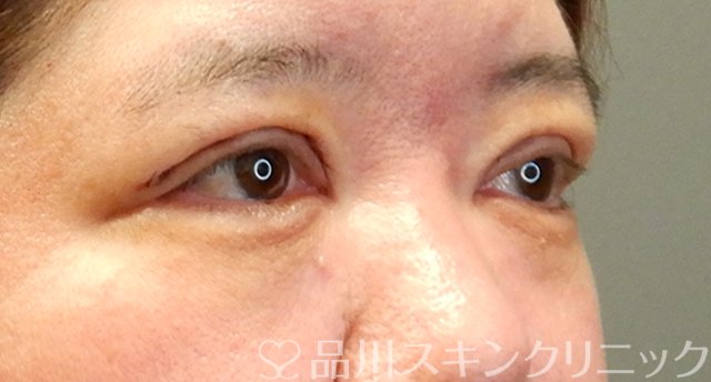 症例NO.64096のAFTER写真